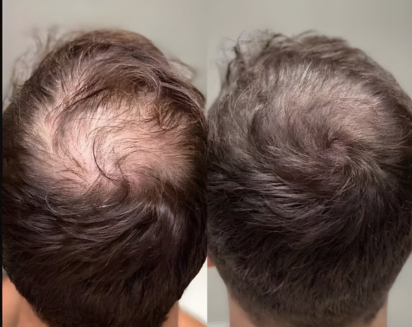 Als jüngerer Typ will man nicht mit Glatze aufwachen. Der Friseur meinte schon vor Monaten, dass es lichter wird. Ich wollte handeln, bevor es zu spät ist. Lumivéra benutzt man nur einmal die Woche – mega unkompliziert. Jetzt wirkt mein Scheitel gleichmäßiger und die dünnen Stellen haben wieder Struktur. Ich hätte nie gedacht, dass ich mich so über Babyhaare freuen kann