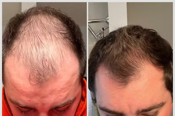 Man redet als Mann selten über so etwas, aber Haarausfall macht etwas mit einem. Bei mir war vor allem die Kopfhaut gestresst, sie war empfindlich und gereizt. Mit Lumivéra hat sich das deutlich beruhigt. Ich merke weniger Brennen und die Haare fühlen sich kräftiger an. Das Beste: Es wurde sogar im Büro bemerkt. Das gibt einem wieder ein anderes Auftreten