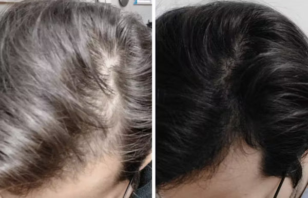 Ich habe Haarausfall nie ernst genommen – bis er mich plötzlich im Alltag begleitet hat. Fotos, Spiegel, beim Sport… alles wurde zur Erinnerung daran, was ich verloren habe. Lumivéra hat mir nicht nur geholfen, die Haare zu stärken, sondern auch mein Selbstbewusstsein. Dass meine Frau irgendwann meinte, ‚Ich glaube, deine Haare kommen zurück‘ – das hat mich richtig stolz gemacht