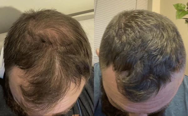 Ich habe mich lange mit meinen Geheimratsecken abgefunden, obwohl es mich jedes Mal getroffen hat, wenn ich in den Spiegel geschaut habe. Nach ein paar erfolglosen Versuchen mit Shampoos und Vitaminen habe ich Lumivéra ausprobiert – ohne große Erwartungen. Schon nach einigen Wochen wurde der Haarausfall beim Duschen weniger. Dann hat meine Freundin gesagt, dass der Haaransatz dichter wirkt. Das war das erste Mal seit Jahren, dass sich etwas wirklich positiv verändert hat. Ich bleibe definitiv dabei