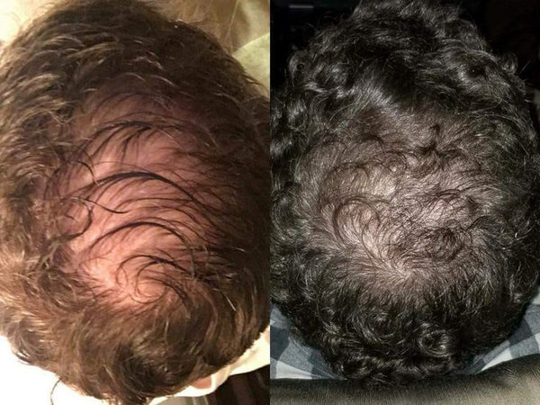 Ich habe alles Mögliche versucht – teure Produkte, fragwürdige Mittel aus dem Internet. Meistens war ich nur enttäuscht. Mit Lumivéra war es das erste Mal, dass sich meine Kopfhaut entspannter anfühlt und ich nicht mehr täglich Haare im Waschbecken sehe. Es gibt mir das Gefühl, nicht mehr zuschauen zu müssen, wie meine Haare verschwinden. Es ist ein gutes Gefühl, wieder Hoffnung zu haben