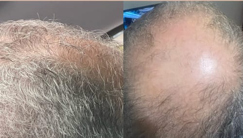 Ich habe irgendwann geglaubt, dass nichts wirklich helfen kann. Aber Lumivéra fühlt sich anders an. Es ist kein Hokuspokus, sondern eine vernünftige Routine, die einfach zu meinem Alltag passt. Das Wichtigste für mich ist: Ich sehe wieder kleine Fortschritte. Nicht über Nacht, aber stetig. Und dieses Gefühl, wieder nach vorne zu schauen statt zurück – das ist für mich der größte Erfolg